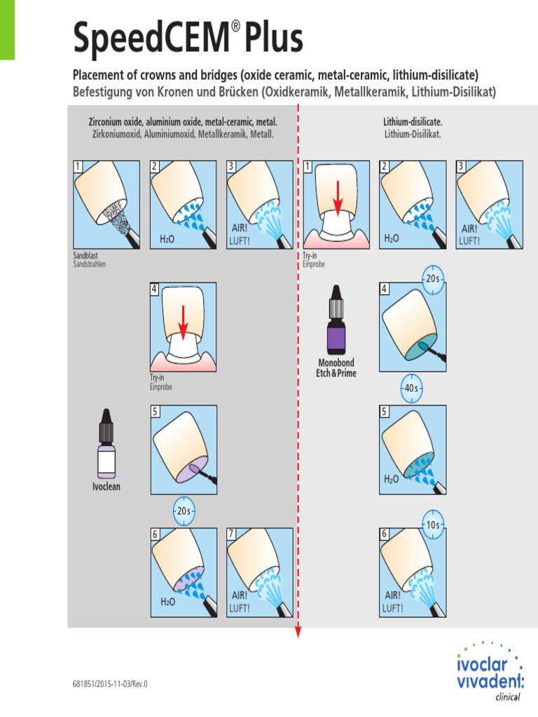 SpeedCEM+Plus - Placement of Crowns and Bridges - en | PDF