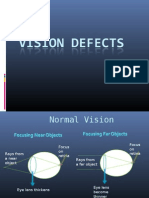Vision Defects