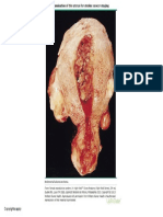 Gross Examination of The Uterus For Uterine Cancer Staging