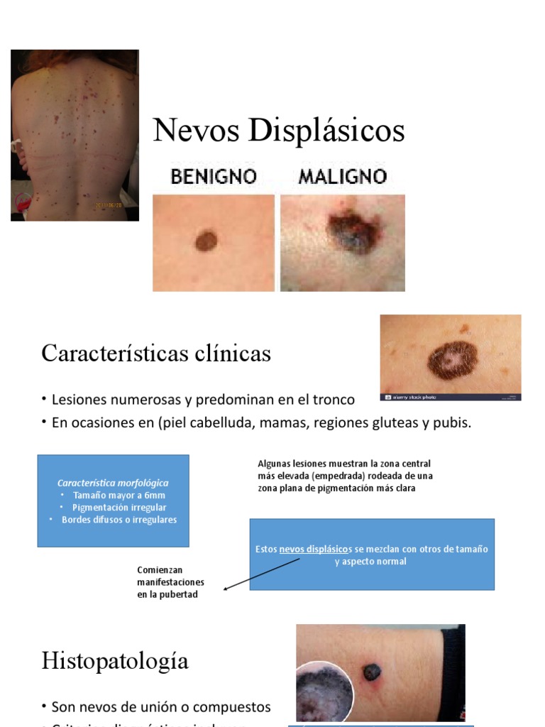 Nevos Displásicos | PDF | Neoplasias | Melanoma, image size:768x1024