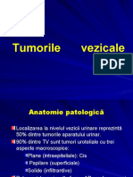 Tumorile Vezicale Si Uretrale 