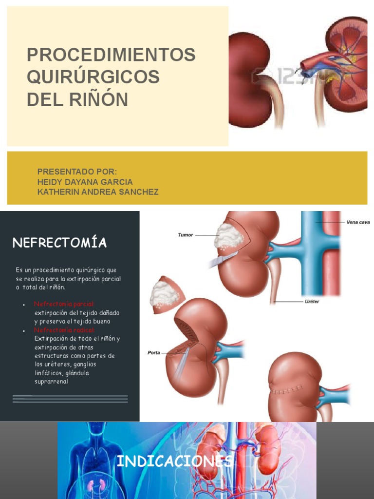 Procedimientos Quirurgicos de Riñon | PDF | Riñón | Abdomen