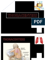 THORACENTESIS