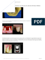 Detalles en la toma de impresiones con siliconas de adición