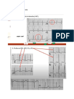 Crecimiento Ventricular Derecha