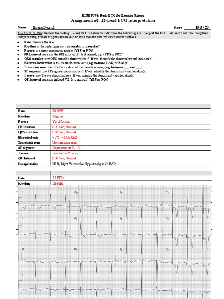 12-Lead ECG Interpretation Guide | PDF