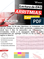 Arritmias Cardíacas