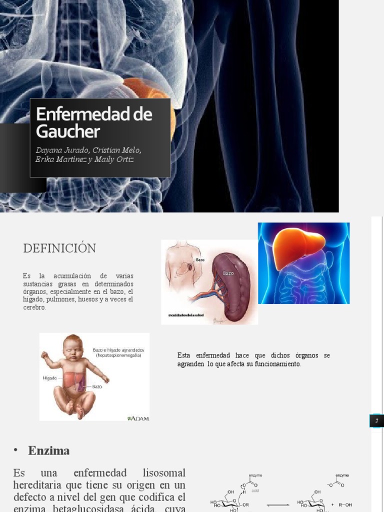 Enfermedad de Gaucher: Tipos y Síntomas | PDF | Enfermedades y ...