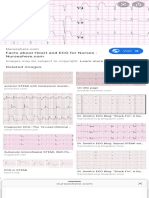 Tombstone Appearance Ecg - Google Search