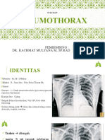 Fatima - Pneumothorax