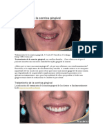 Tratamiento de La Sonrisa Gingival