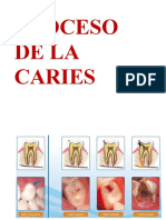 CARIES