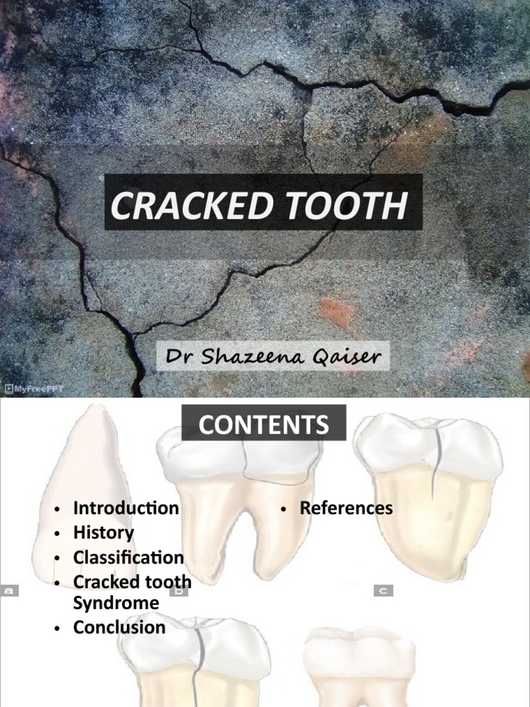 Cracked Tooth Syndrome | PDF | Human Tooth | Tooth