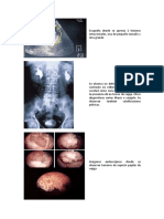 Tumores Vejiga 1 PDF