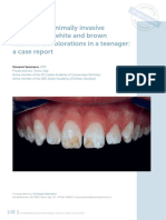 Combined minimally invasive treatment of white and brown fluorotic discolorations in a teenager
