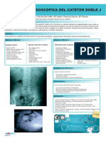 Colocacion Endoscopica Cateter Doble-J PDF