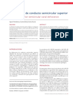 Dehiscencia de Conducto Semicircular Superior