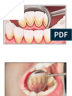 Placas Dentales