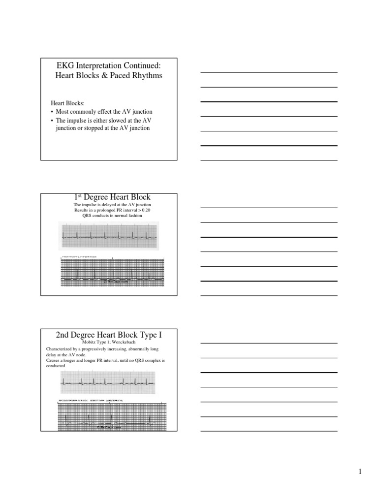 EKG Interpretation Continued: Heart Blocks & Paced Rhythms | PDF