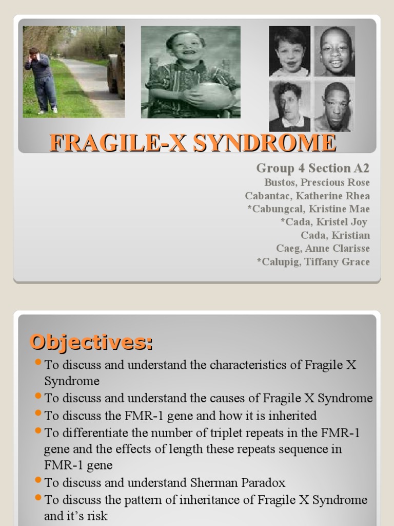 Understanding Fragile X Syndrome | PDF | Polymerase Chain Reaction ...