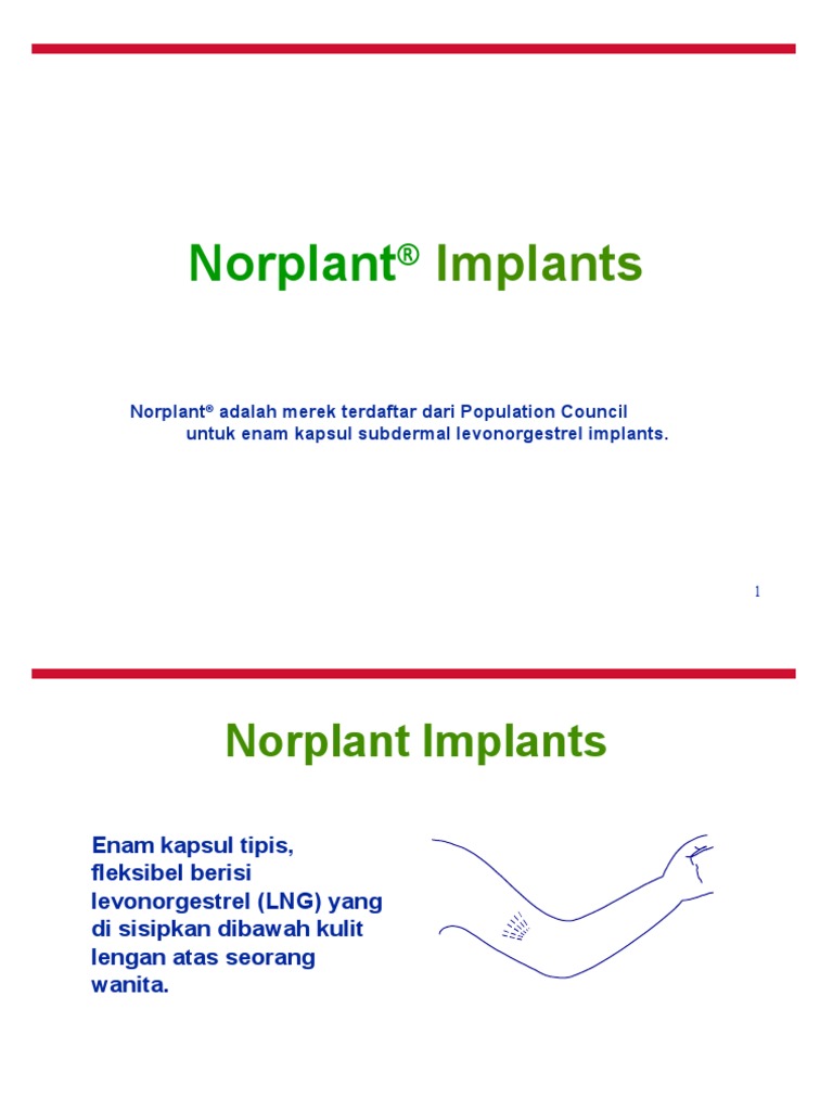 Norplan Implan | PDF