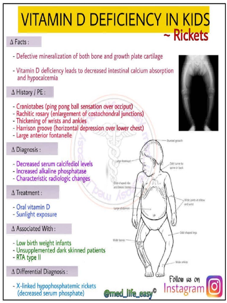 Vitamin D Deficiency in Kids (Rickets) PDF