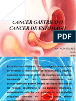 Cancer Gastrico o Cancer de Estomago