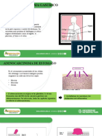 Adenocarcinoma Gastrico: Estomago