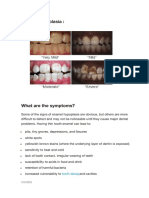 Enamel Hypoplasia:: Tooth Decay