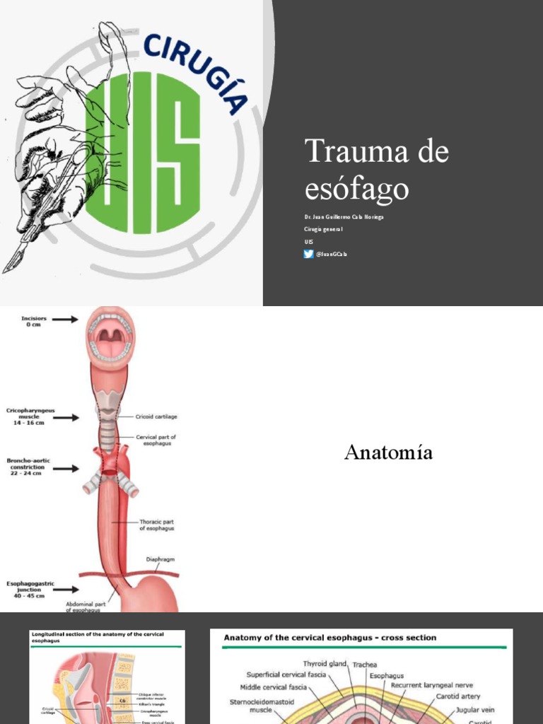 Manejo del Trauma Esofágico: Diagnóstico y Tratamiento | PDF ...