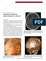 Spontaneous Ping-Pong Parietal Fracture in A Newborn: Images in Neonatal Medicine