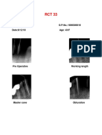 RCT 33 - Ramadevi O.P.No. 1806300010 Root Canal Treatment