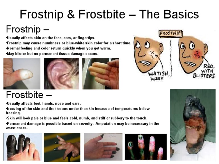 Frostnip & Frostbite The Basics PDF