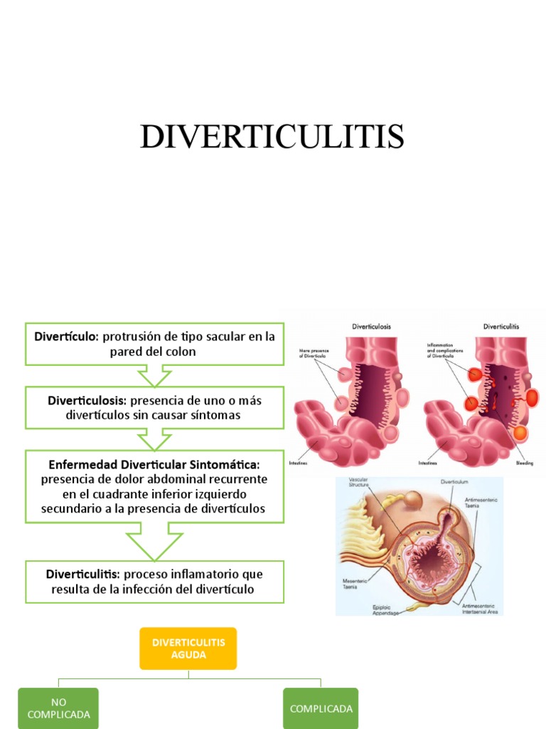 DIVERTICULITIS | PDF