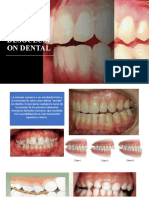 Desoclusion Dental