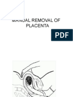 Manual Removal of Placenta