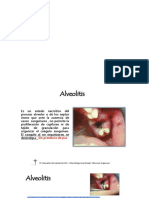 Alveolitis PDF