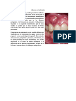 Abscesos Periodontales