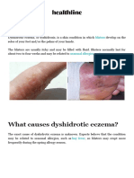 ECZEMA Type Discoid and Dyshidrotic