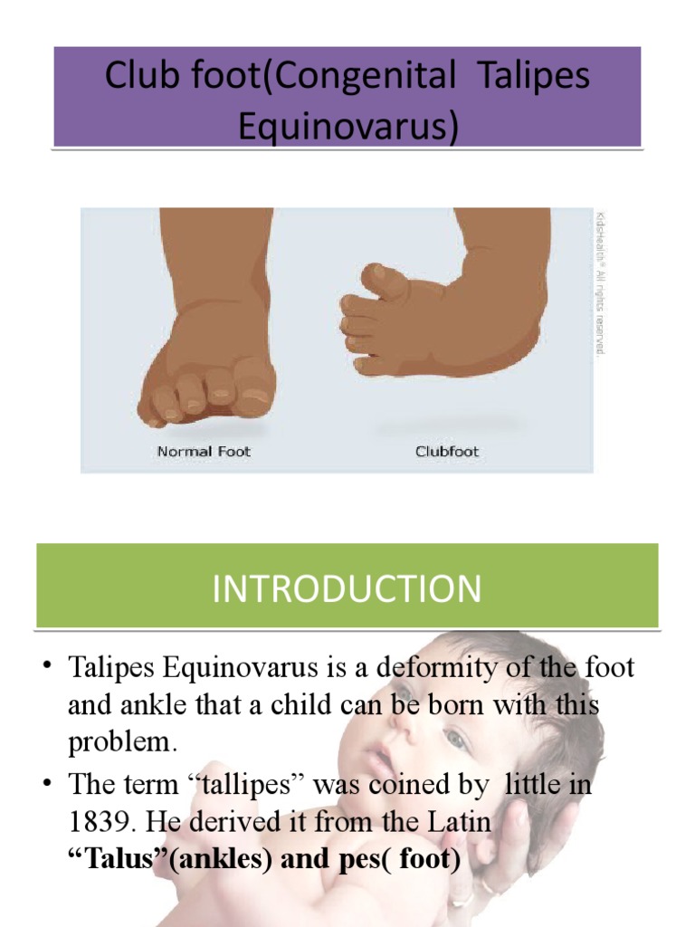 Club Foot Pdf Foot Congenital Disorder