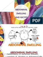Abdominal Sweliing and Ascites