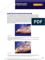 Osteotomía Metatarsiana Distal Angular para El Hallux Valgus