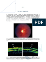 Oct en El Glaucoma