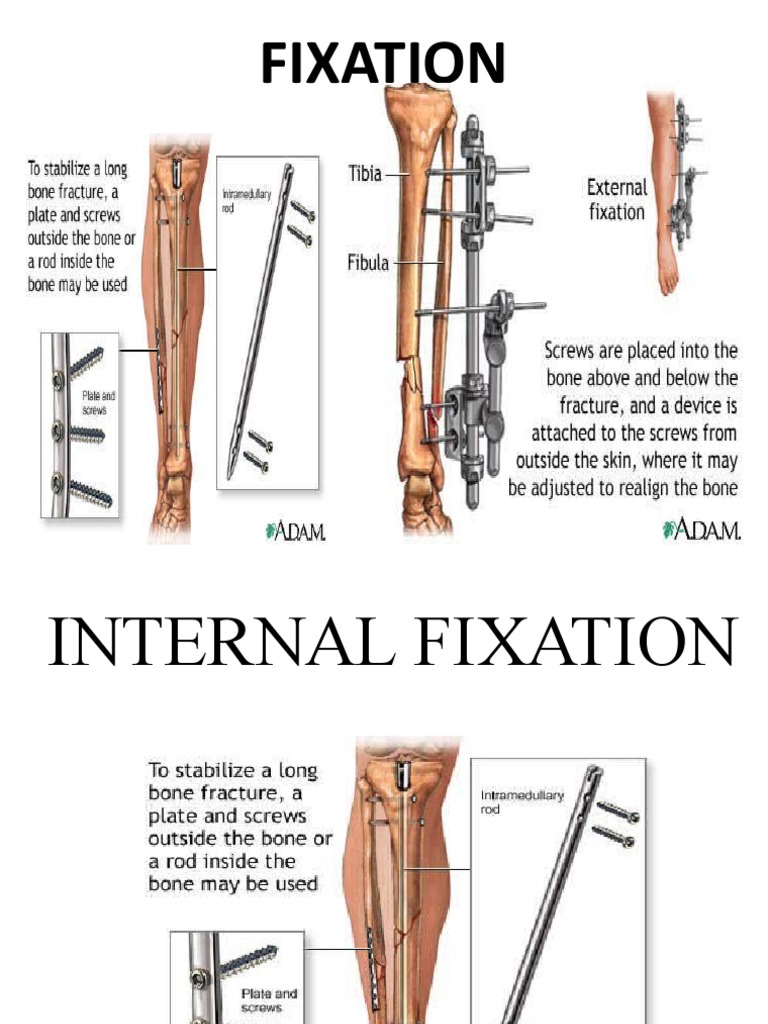Femur Spanning External Fixator Get Images