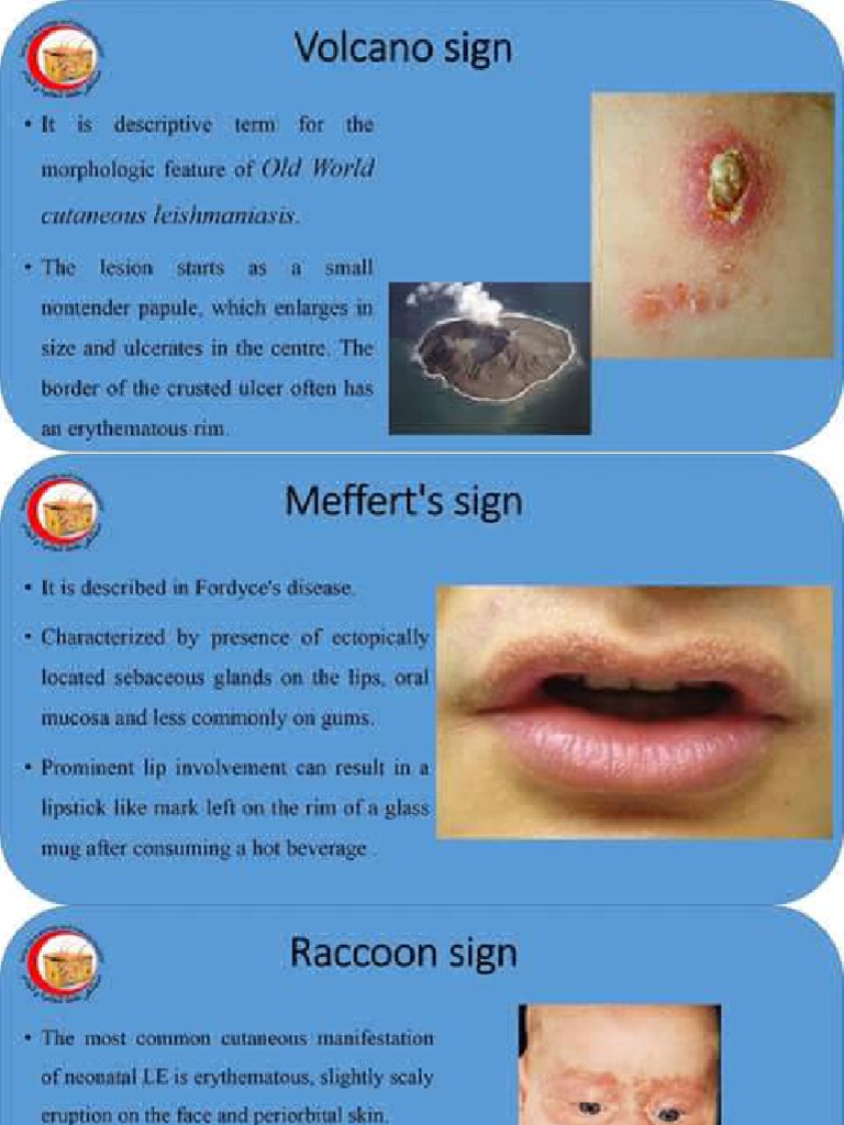 SIGNS IN MEDICINE - DR Akshita Mangal-1-1 PDF | PDF