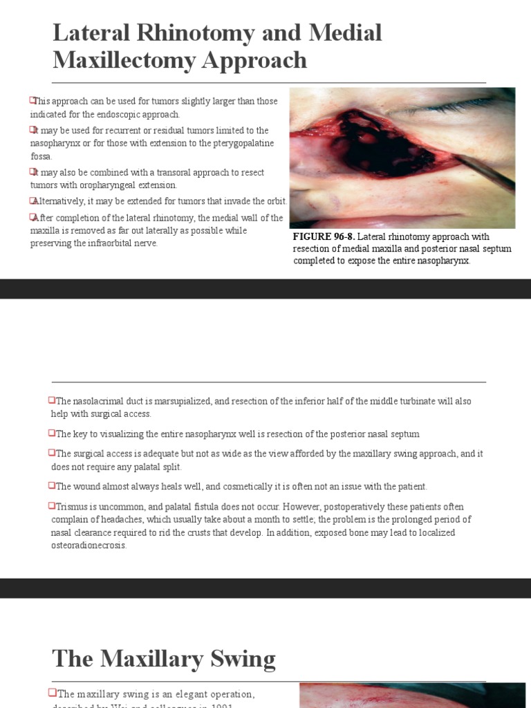 Lateral Rhinotomy and Maxillary Swing Approaches | PDF | Surgery ...