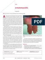 Amyotrophic Dermatomyositis PDF