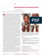 Erythrodermic Paraneoplastic Dermatomyositis: Practice - Clinical Images