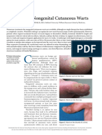 Treatment of Nongenital Cutaneous Warts