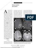 Brain Septic Embolism in Endocarditidis